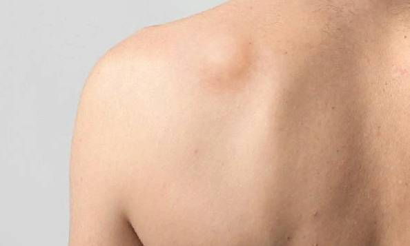 На спине под лопаткой появилась шишка болит