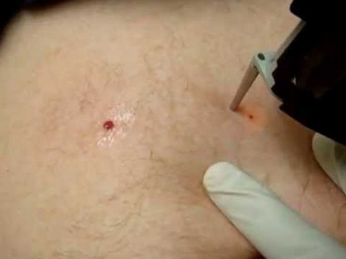 На спине под лопаткой появилась шишка болит