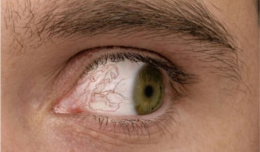 При повороте глаз болит голова