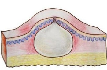 На спине под лопаткой появилась шишка болит