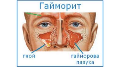 При температуре начинает болеть спина