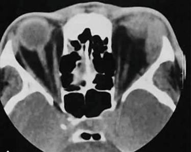 При температуре начинает болеть спина