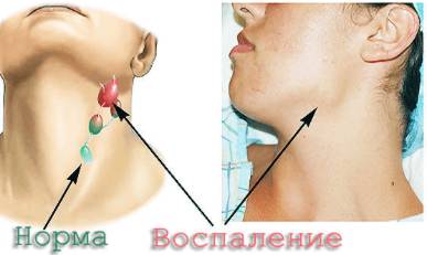 При температуре начинает болеть спина