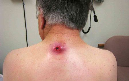 Атерома на спине