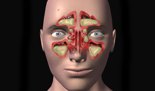 Головная боль без температуры при простудных заболеваниях