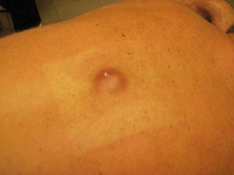 На спине под лопаткой появилась шишка болит