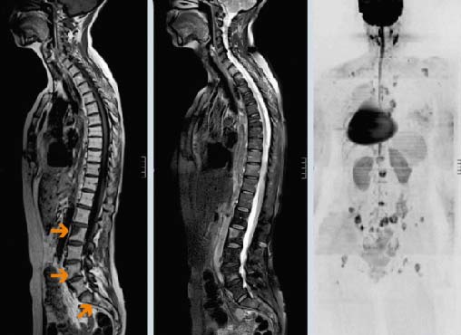 Если болит спина при раке молочной железы