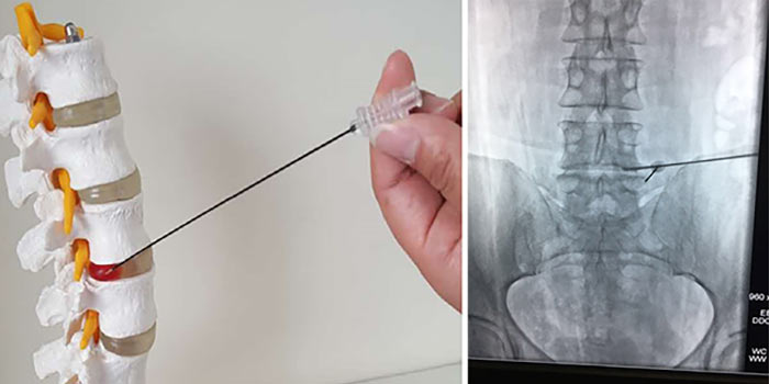 Если болит спина при раке молочной железы