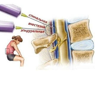 Спинальная анестезия Спинальная анестезия