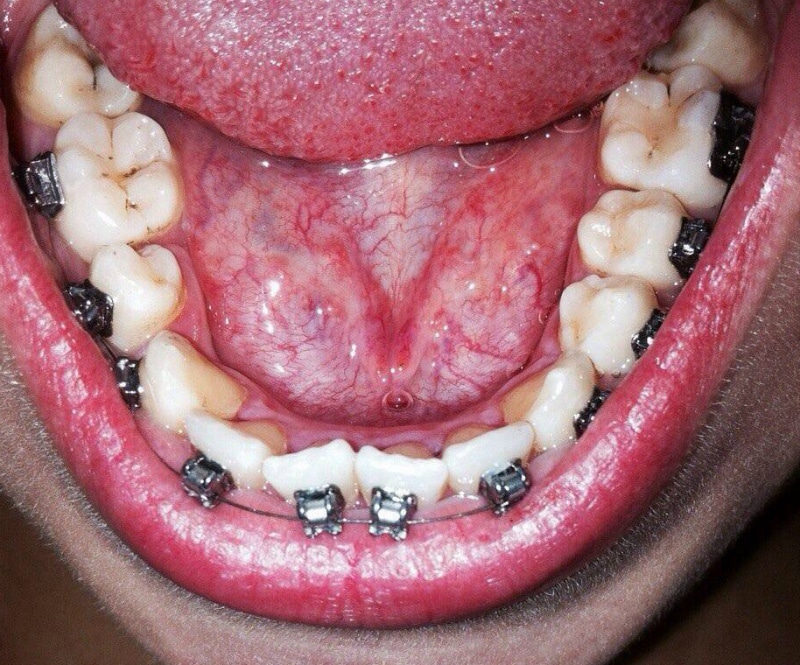 Использование брекет-системы Использование брекет-системы